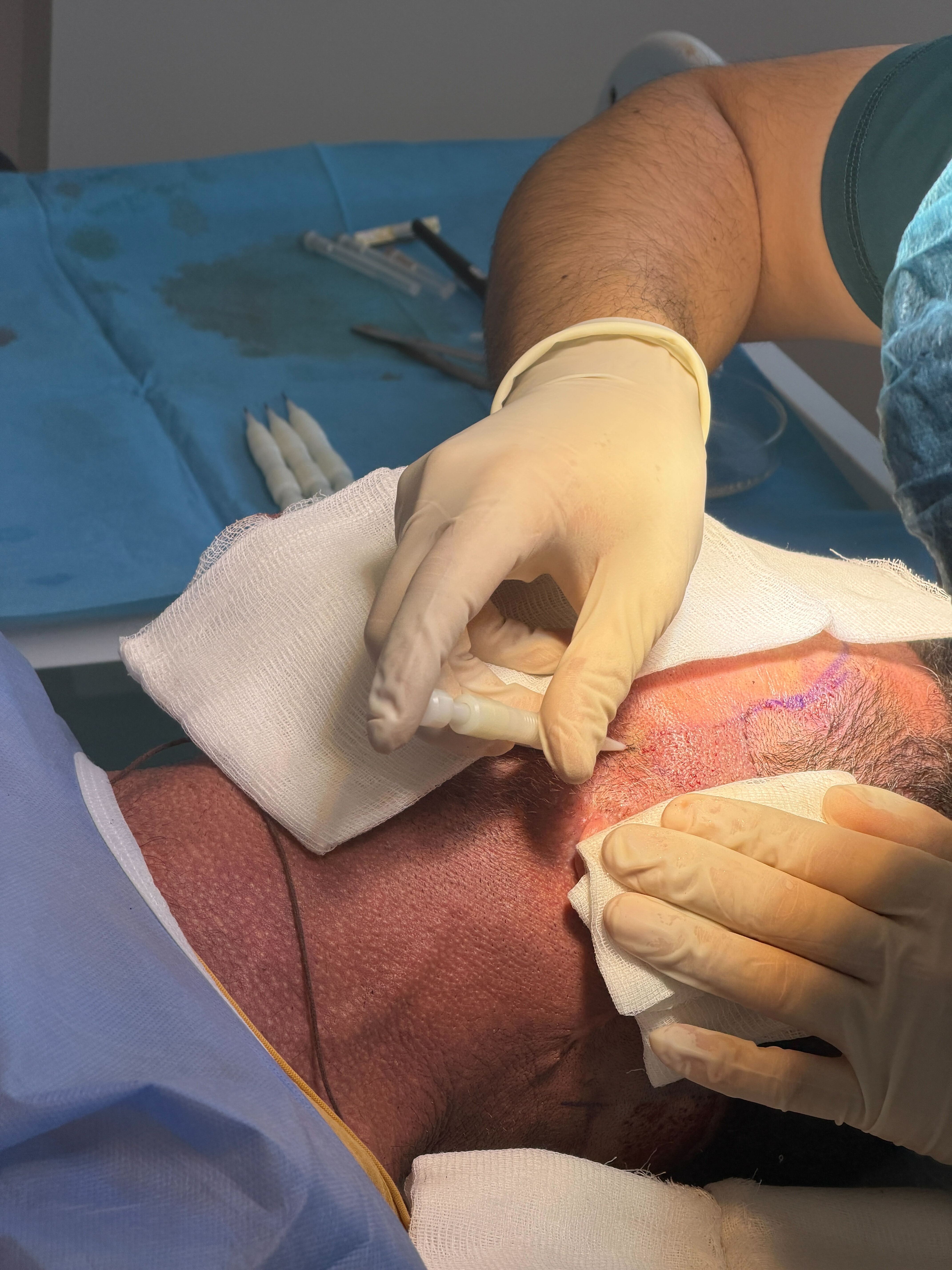 Metodat FUE dhe DHI për transplantin e mjekrës